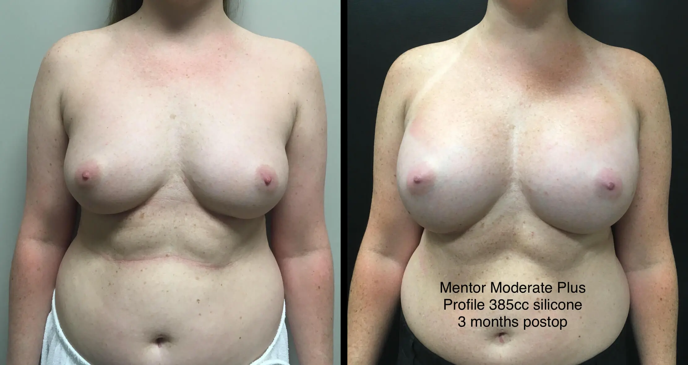 BREAST AUGMENTATION Before & After Case Number 00021
