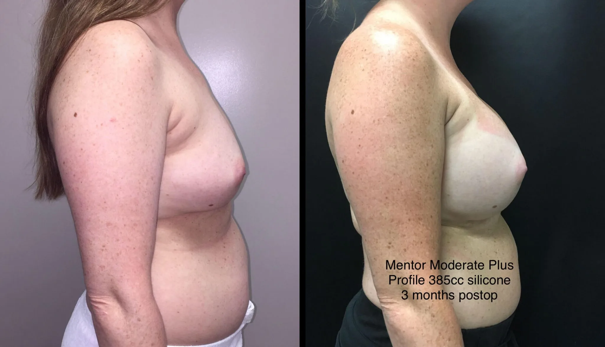 BREAST AUGMENTATION Before & After Case Number 00021
