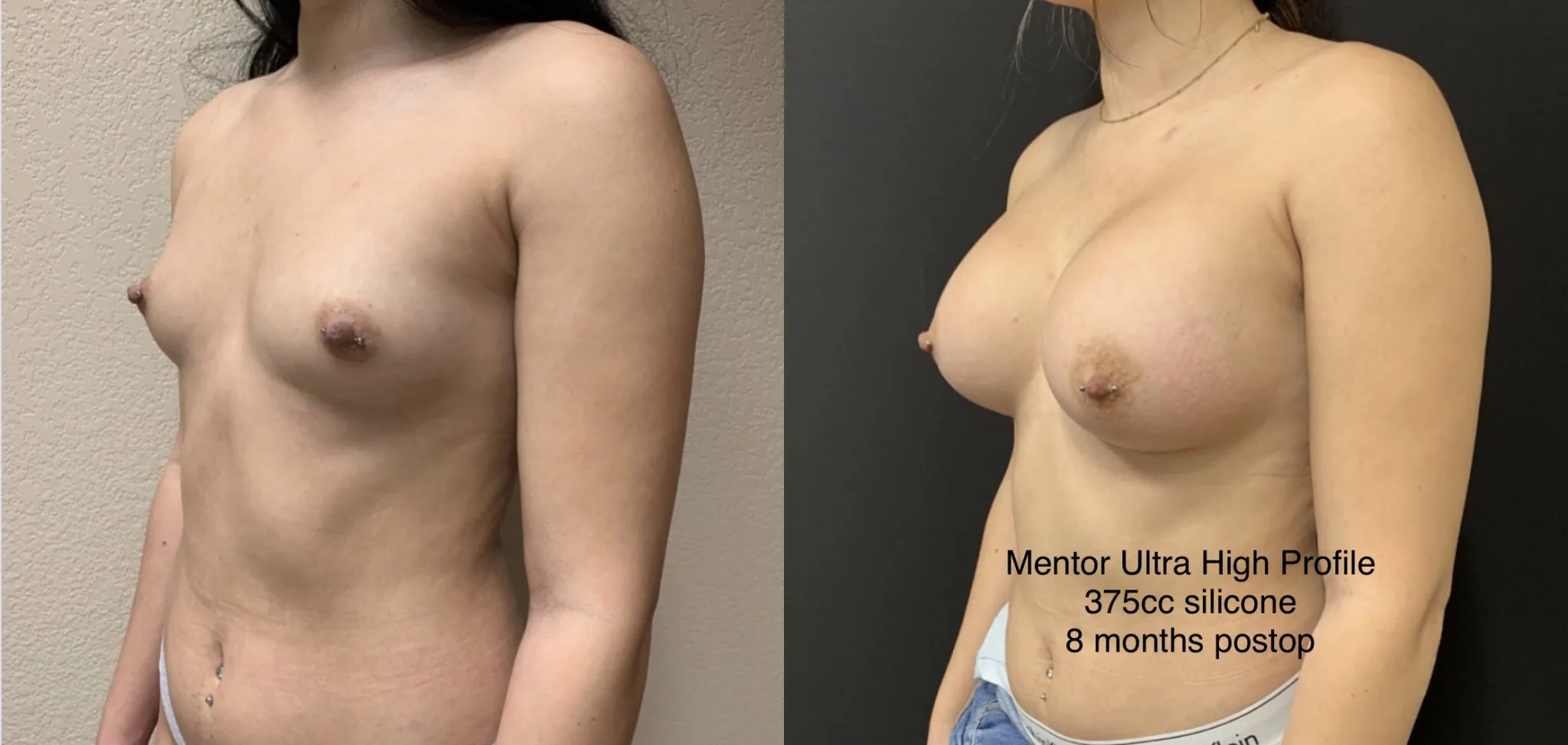 BREAST AUGMENTATION Before & After Case Number 00030