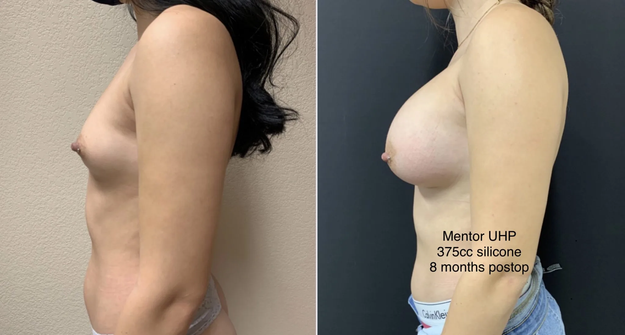 BREAST AUGMENTATION Before & After Case Number 00030