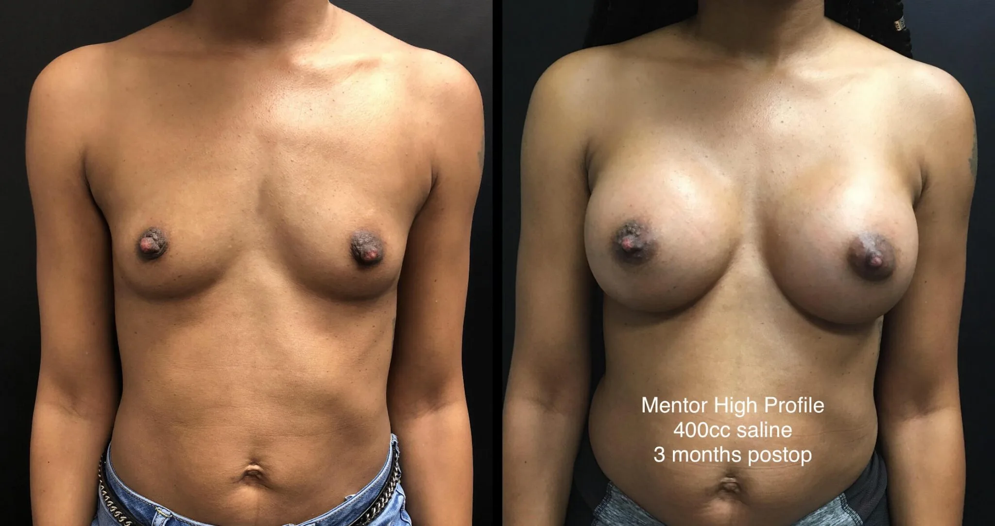BREAST AUGMENTATION Before & After Case Number 00034