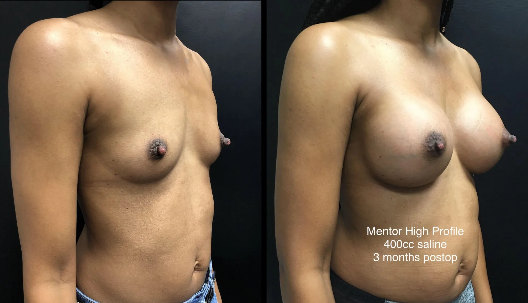 BREAST AUGMENTATION Before & After Case Number 00034
