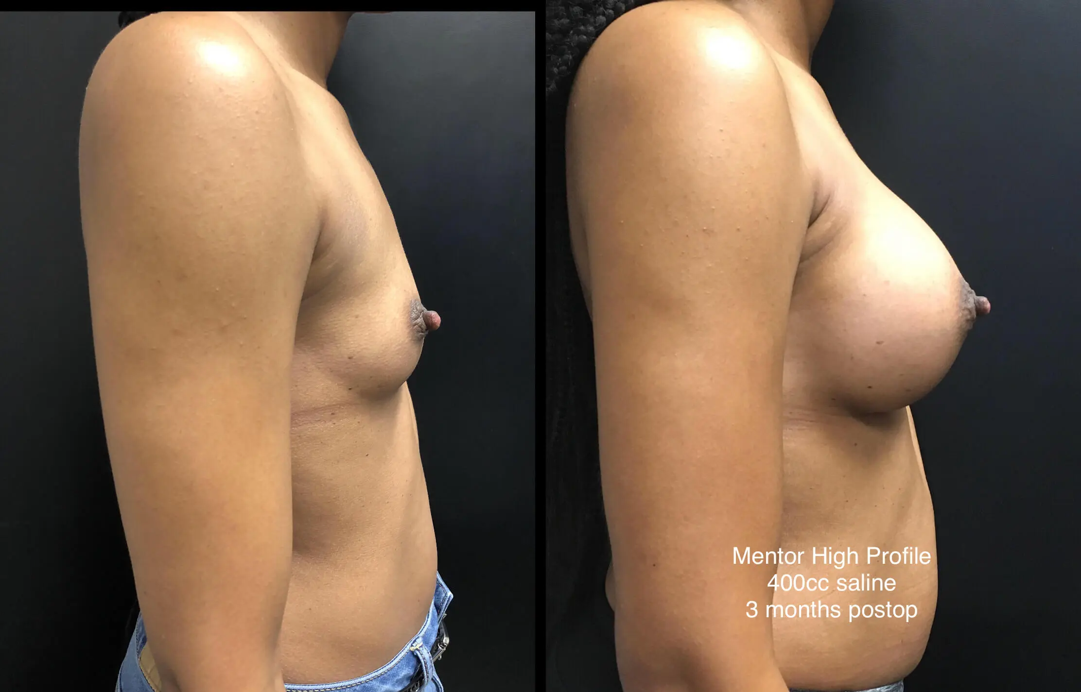 BREAST AUGMENTATION Before & After Case Number 00034