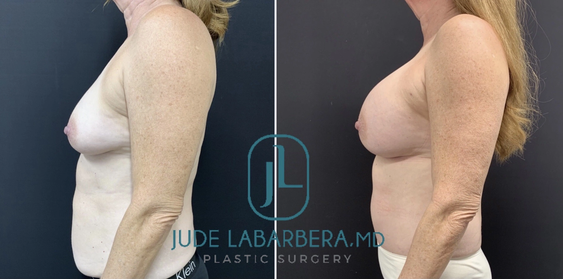 BREAST AUGMENTATION Before & After Case Number 00057