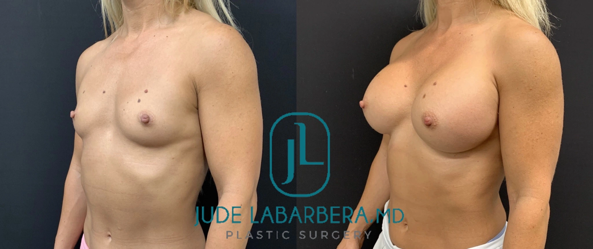BREAST AUGMENTATION Before & After Case Number 00068