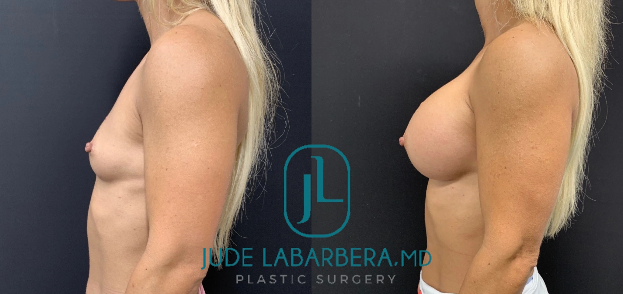 BREAST AUGMENTATION Before & After Case Number 00068