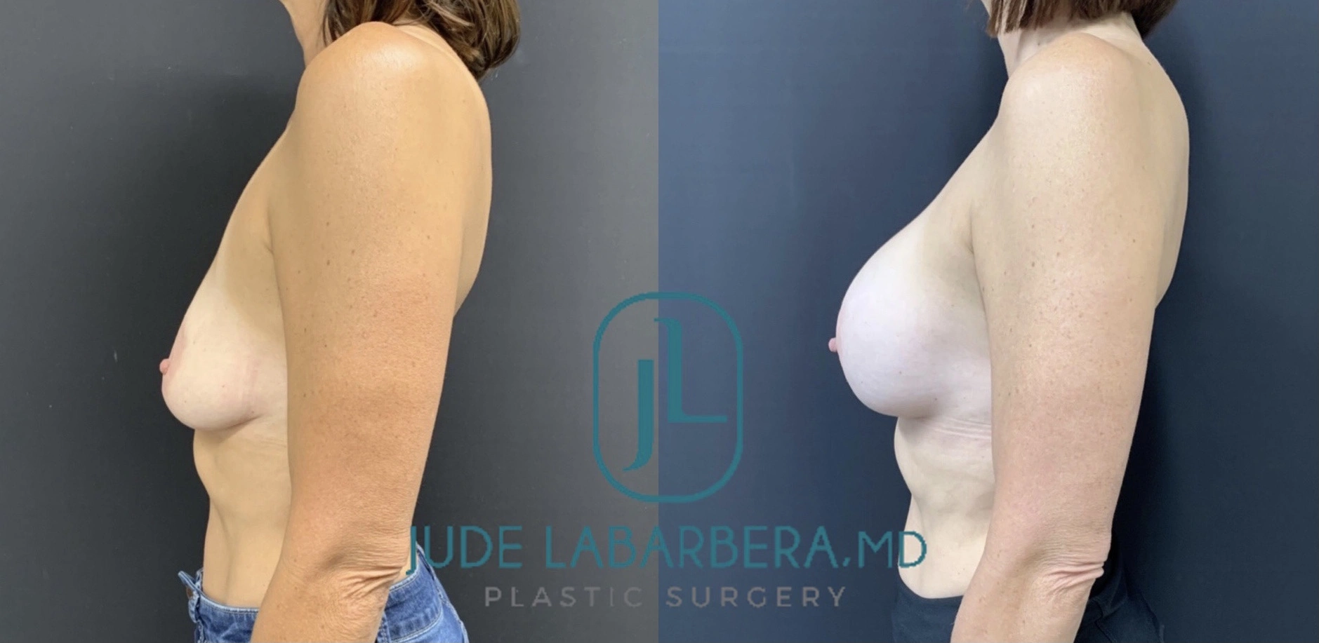 BREAST AUGMENTATION Before & After Case Number 0009