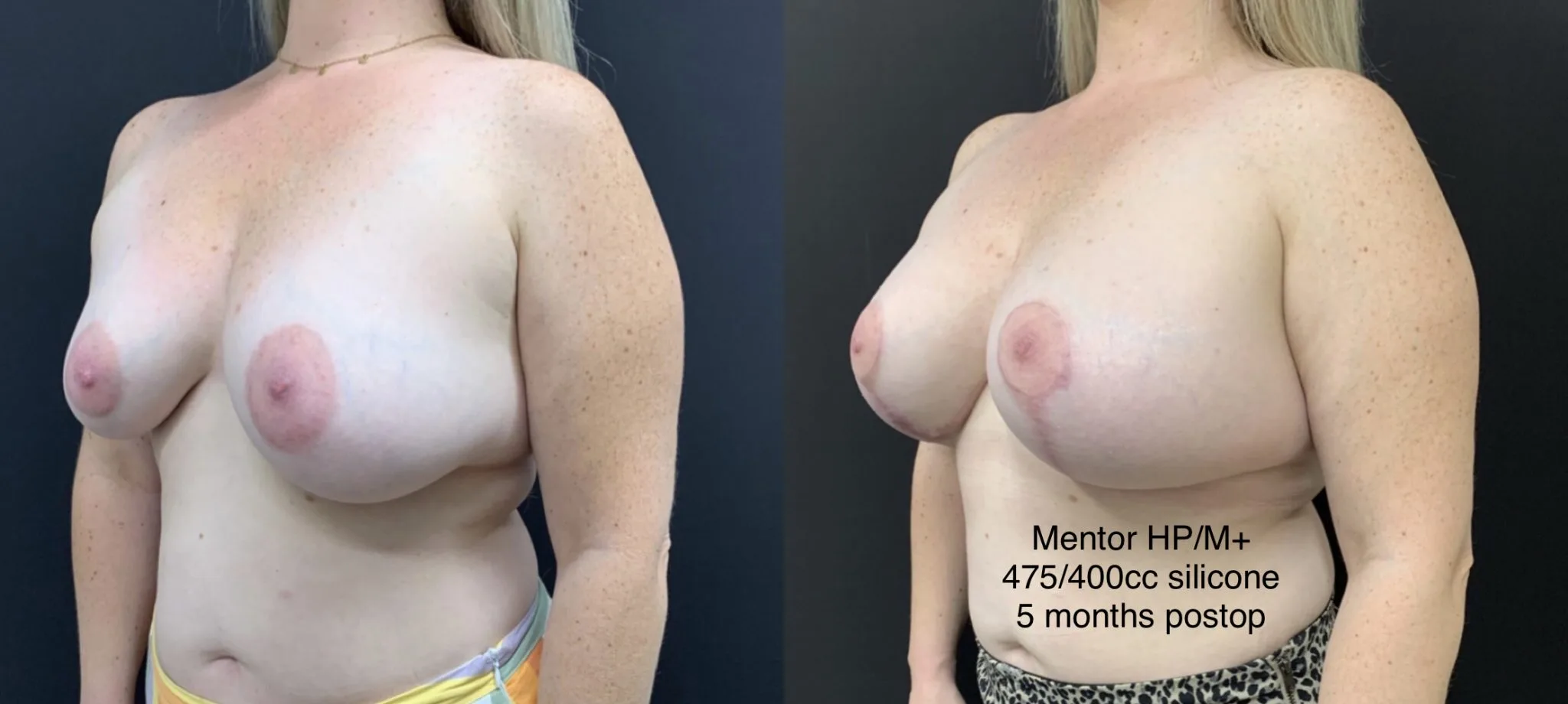 BREAST AUGMENTATION WITH LIFT Before & After Case Number 0003
