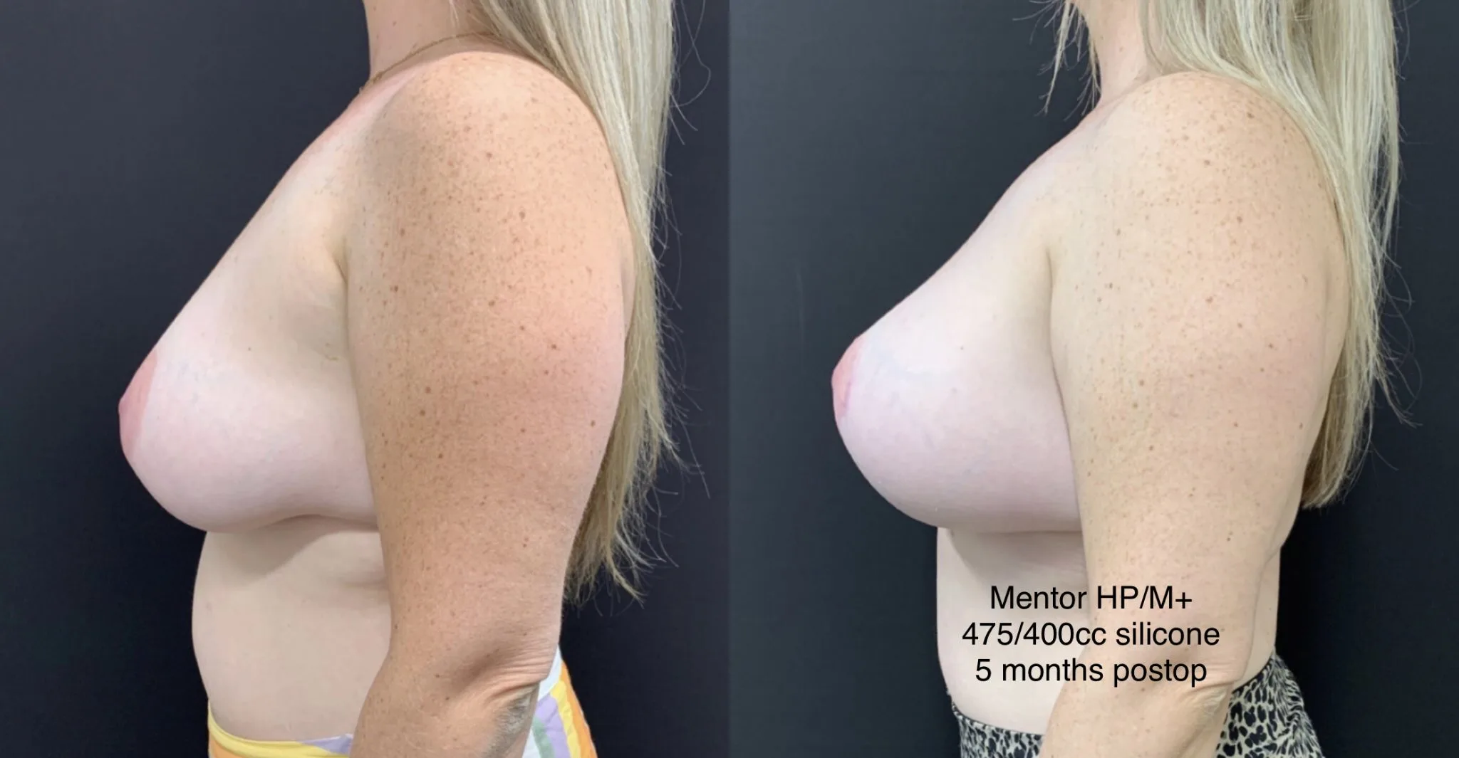 BREAST AUGMENTATION WITH LIFT Before & After Case Number 0003