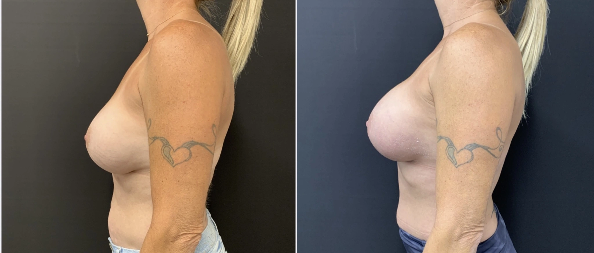 BREAST IMPLANT EXCHANGE Before & After Case Number 0008