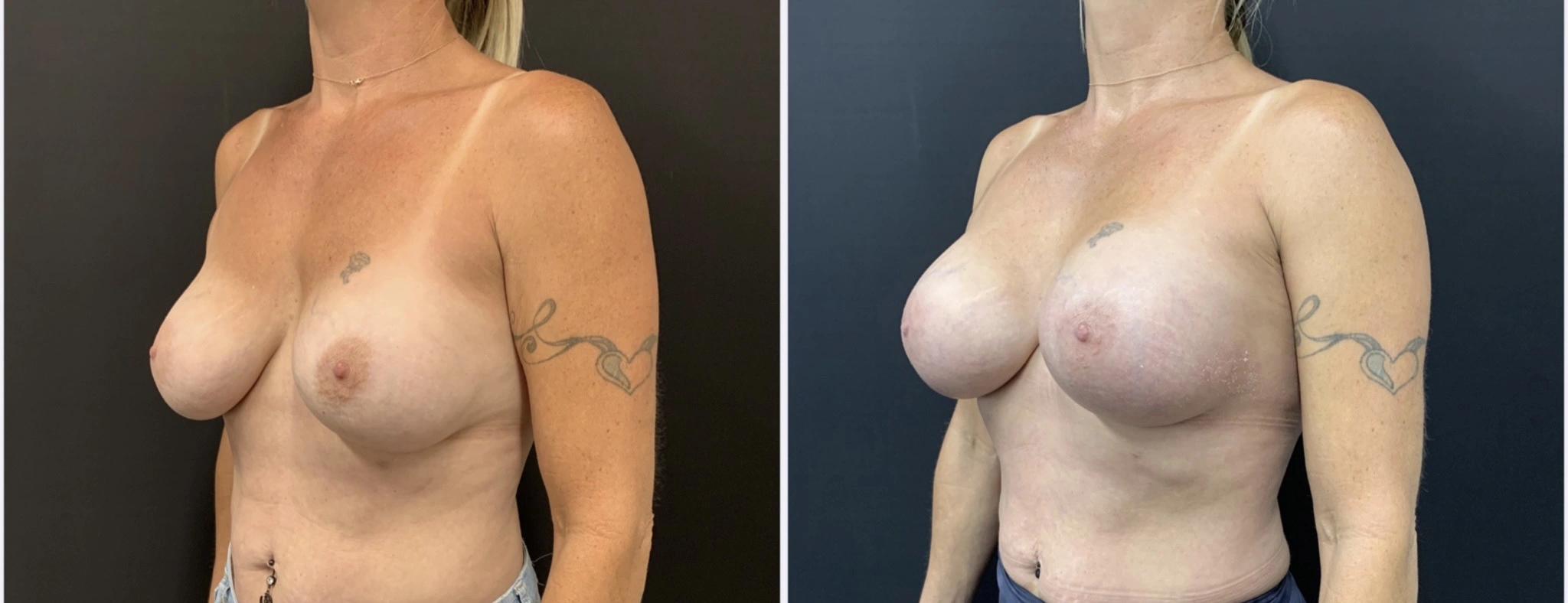 BREAST IMPLANT EXCHANGE Before & After Case Number 0008