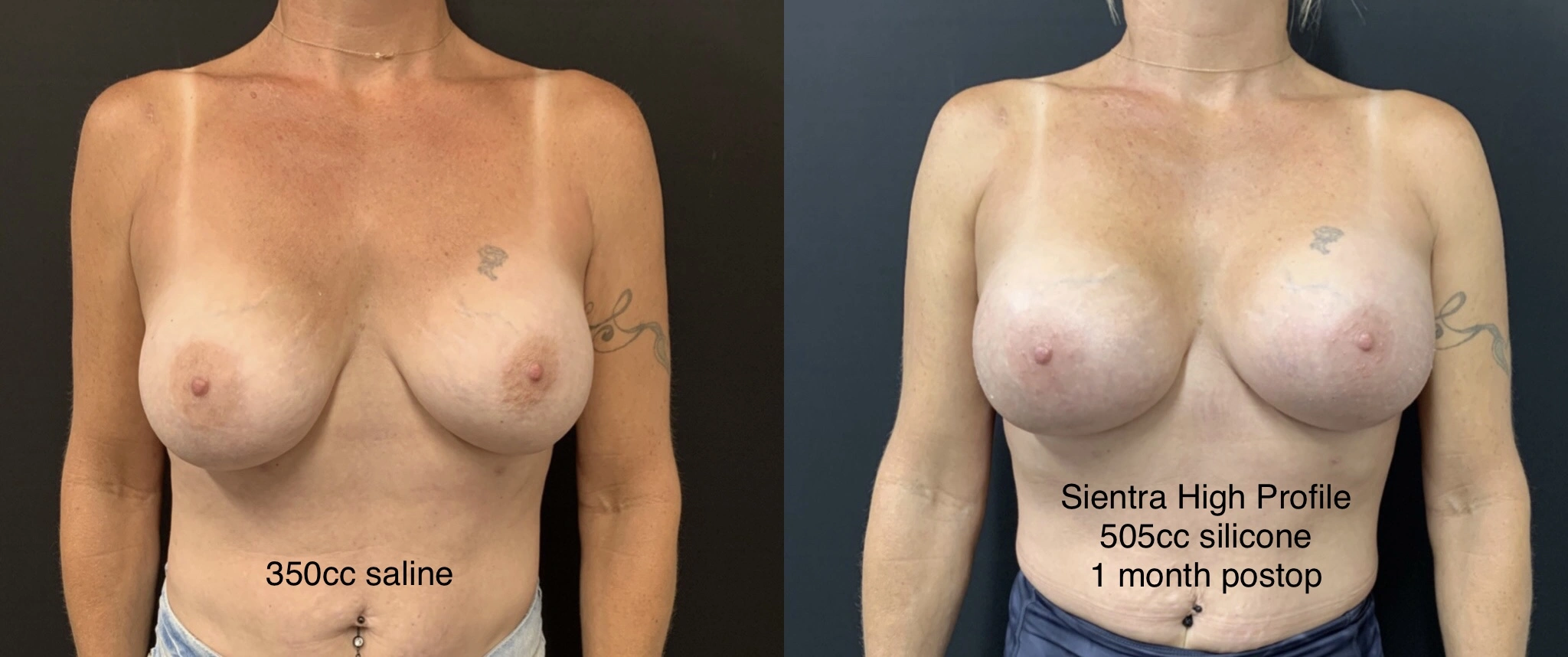 BREAST IMPLANT EXCHANGE Before & After Case Number 0008