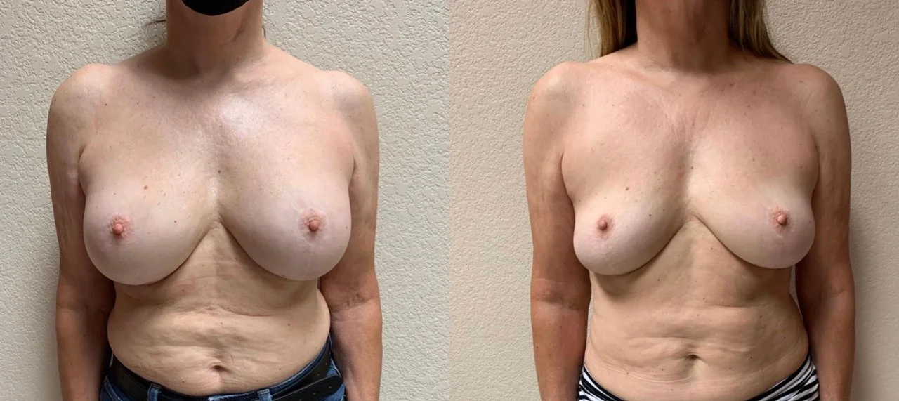Breast IMPLANT REMOVAL Before & After Case 108