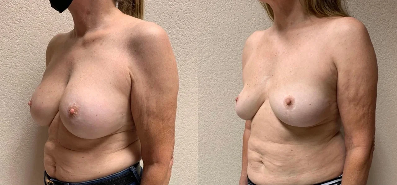 Breast IMPLANT REMOVAL Before & After Case 108