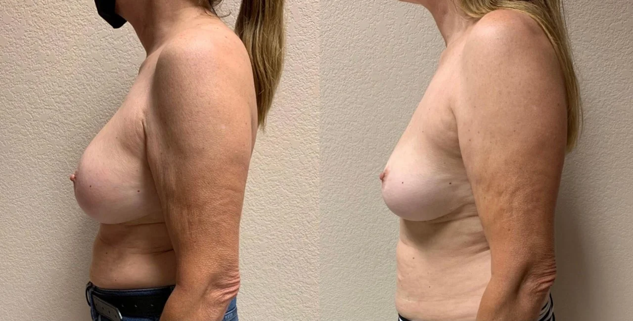 Breast IMPLANT REMOVAL Before & After Case 108