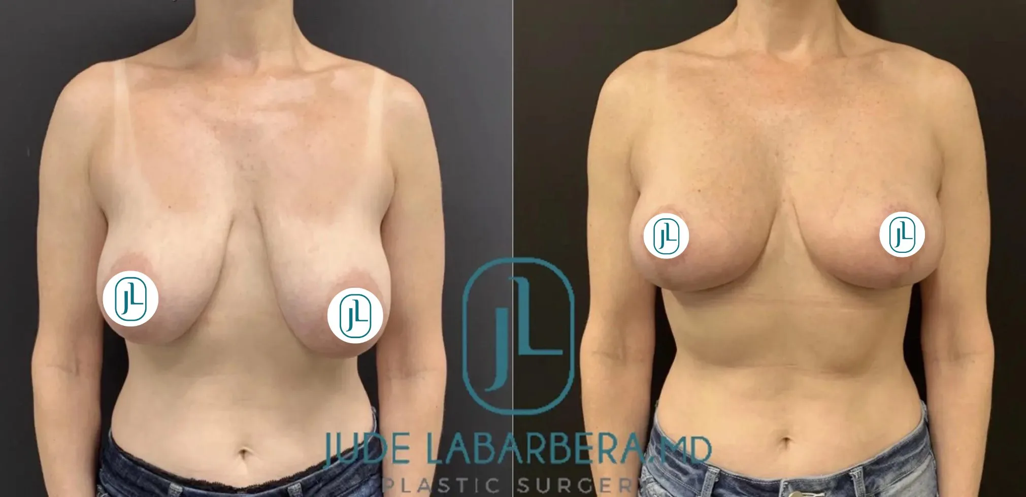 Breast Lift before & after