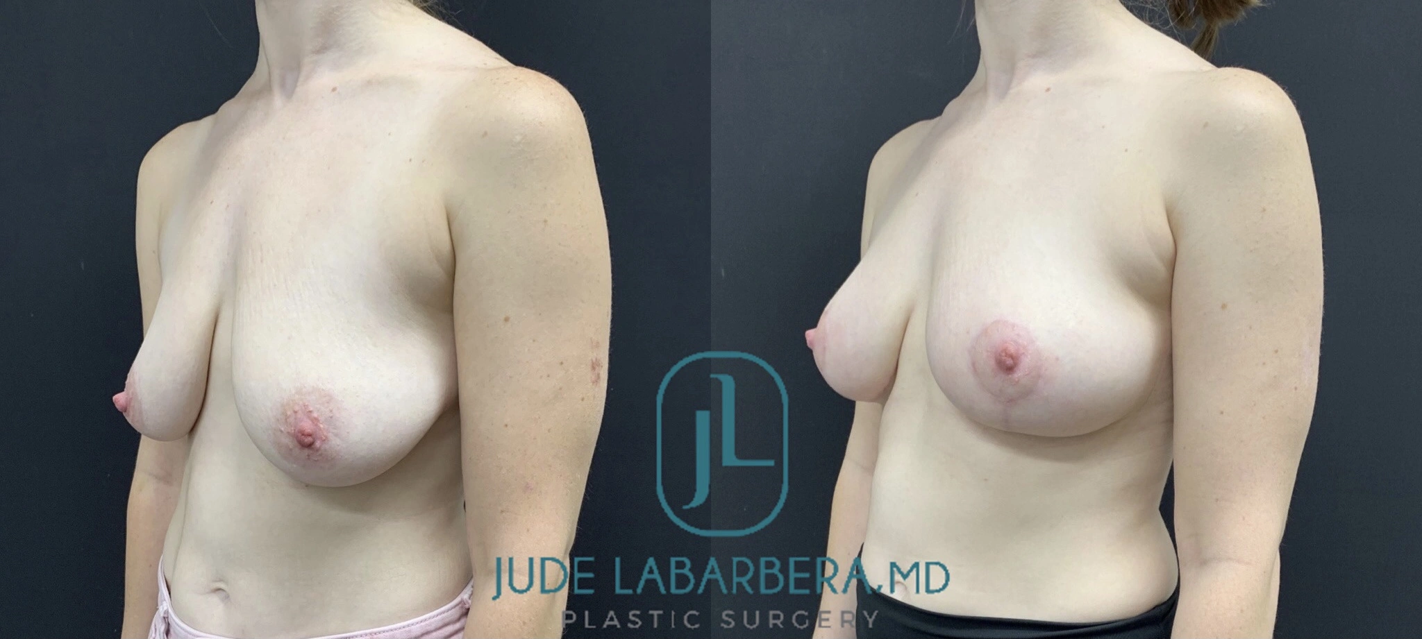 BREAST LIFT Before & After Case Number 00012