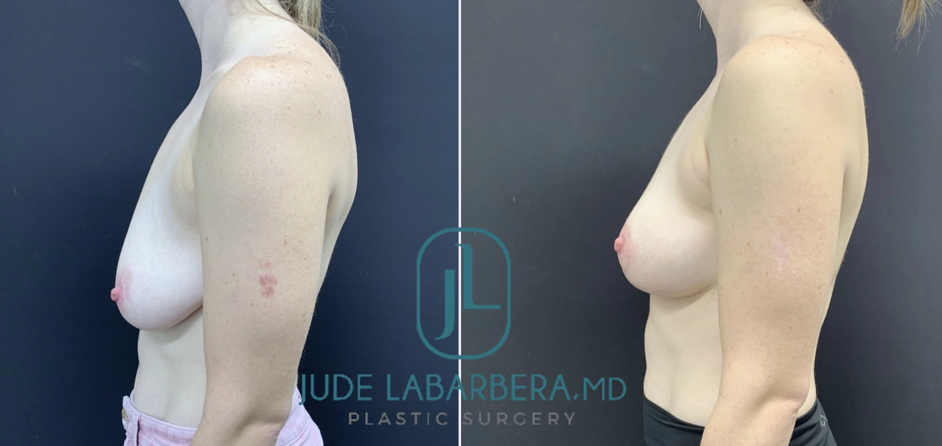BREAST LIFT Before & After Case Number 00012