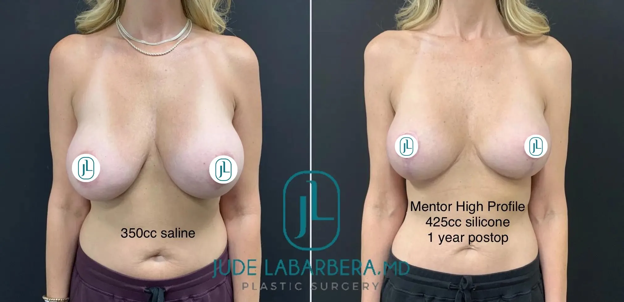 Breast Lift before & after