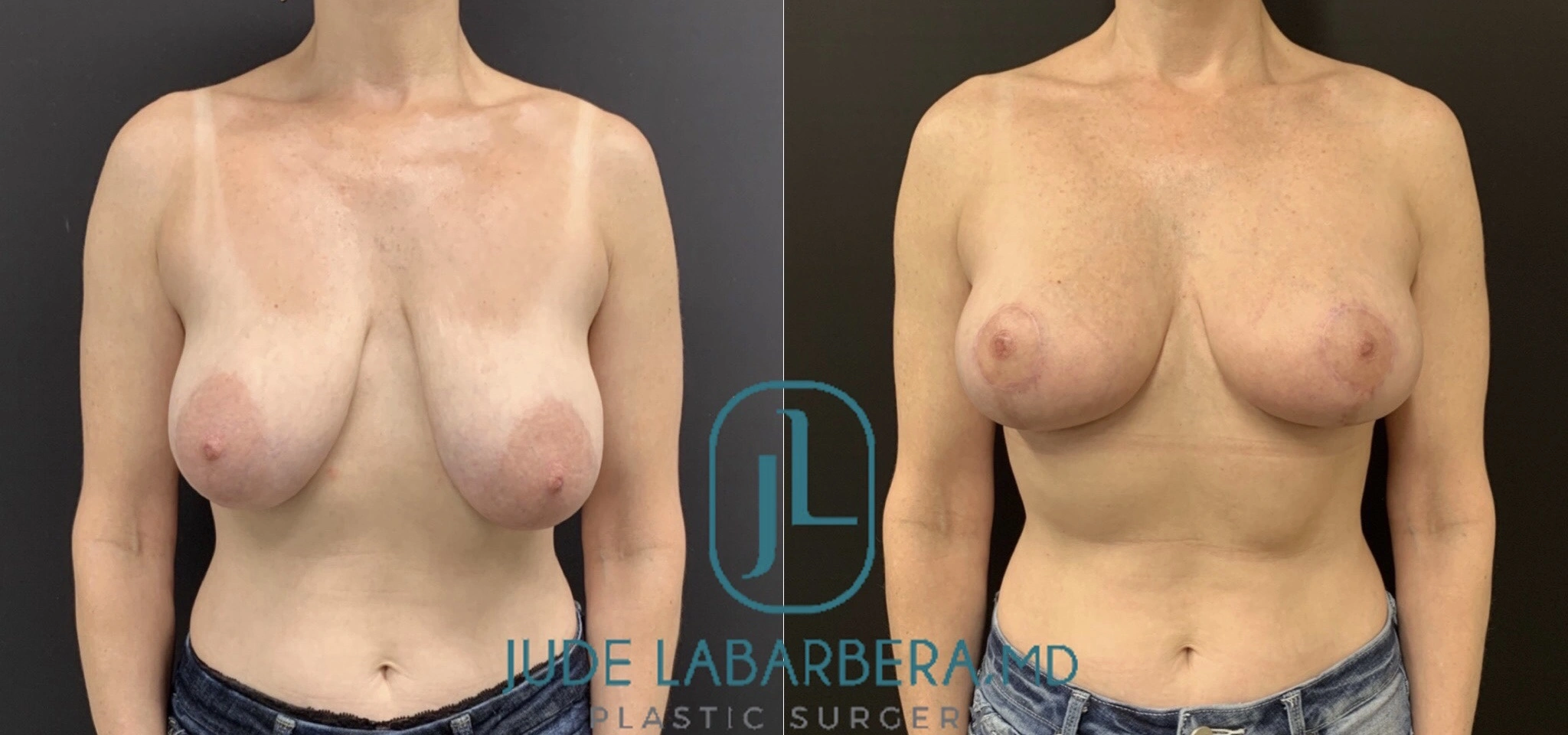 BREAST LIFT WITH NO IMPLANTS Before & After Case Number 0008