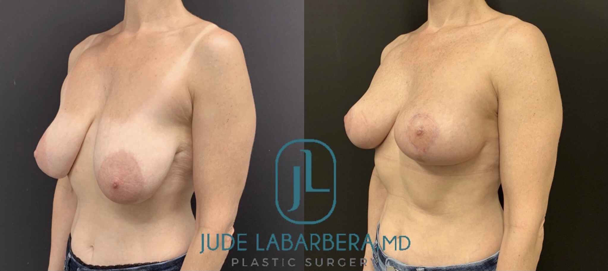 BREAST LIFT WITH NO IMPLANTS Before & After Case Number 0008