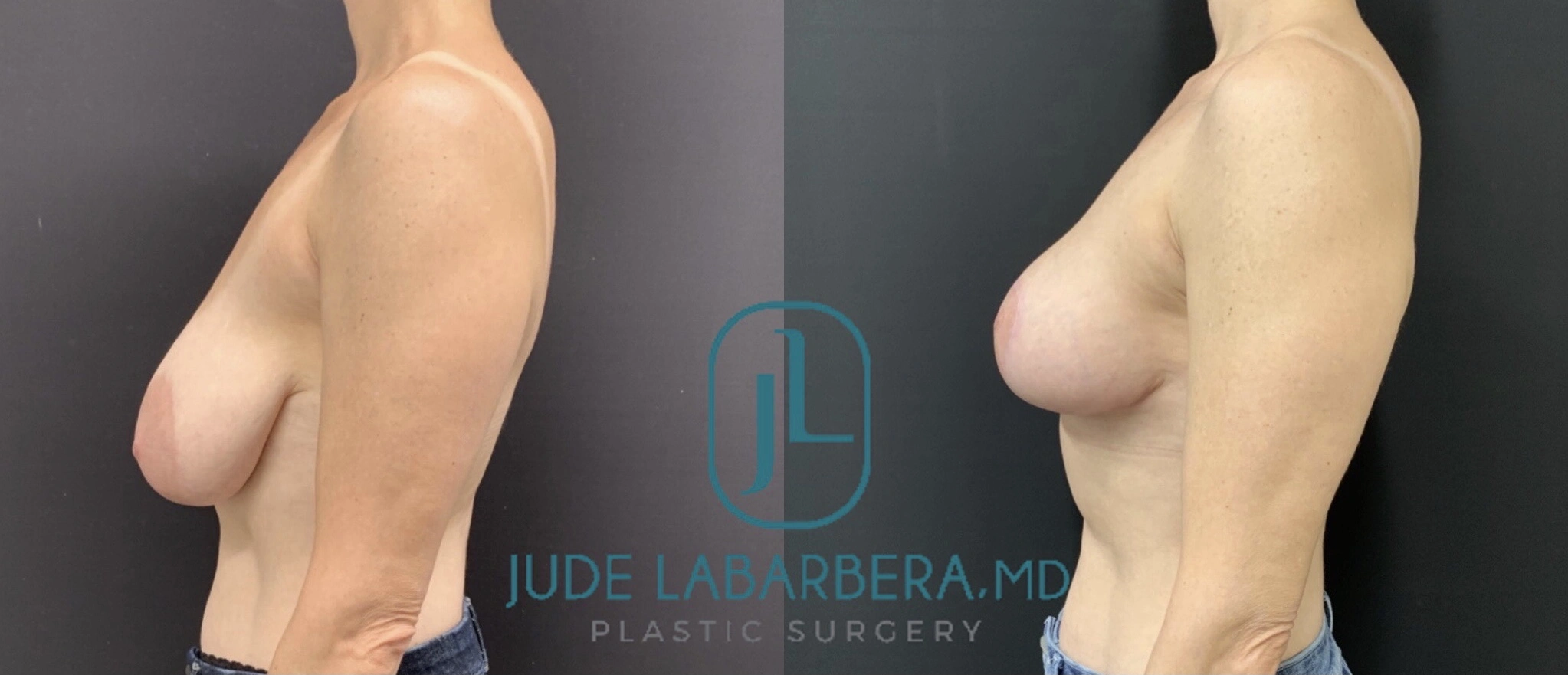 BREAST LIFT WITH NO IMPLANTS Before & After Case Number 0008