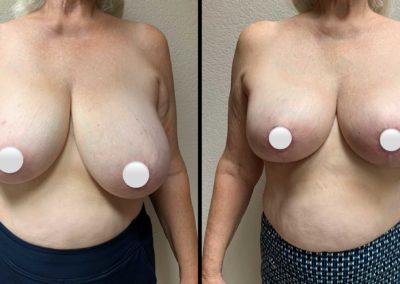 BREAST RECONSTRUCTION Before & After