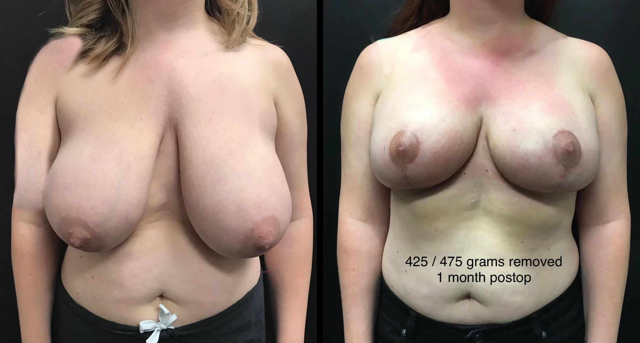 BREAST REDUCTION Before & After Case Number 0003