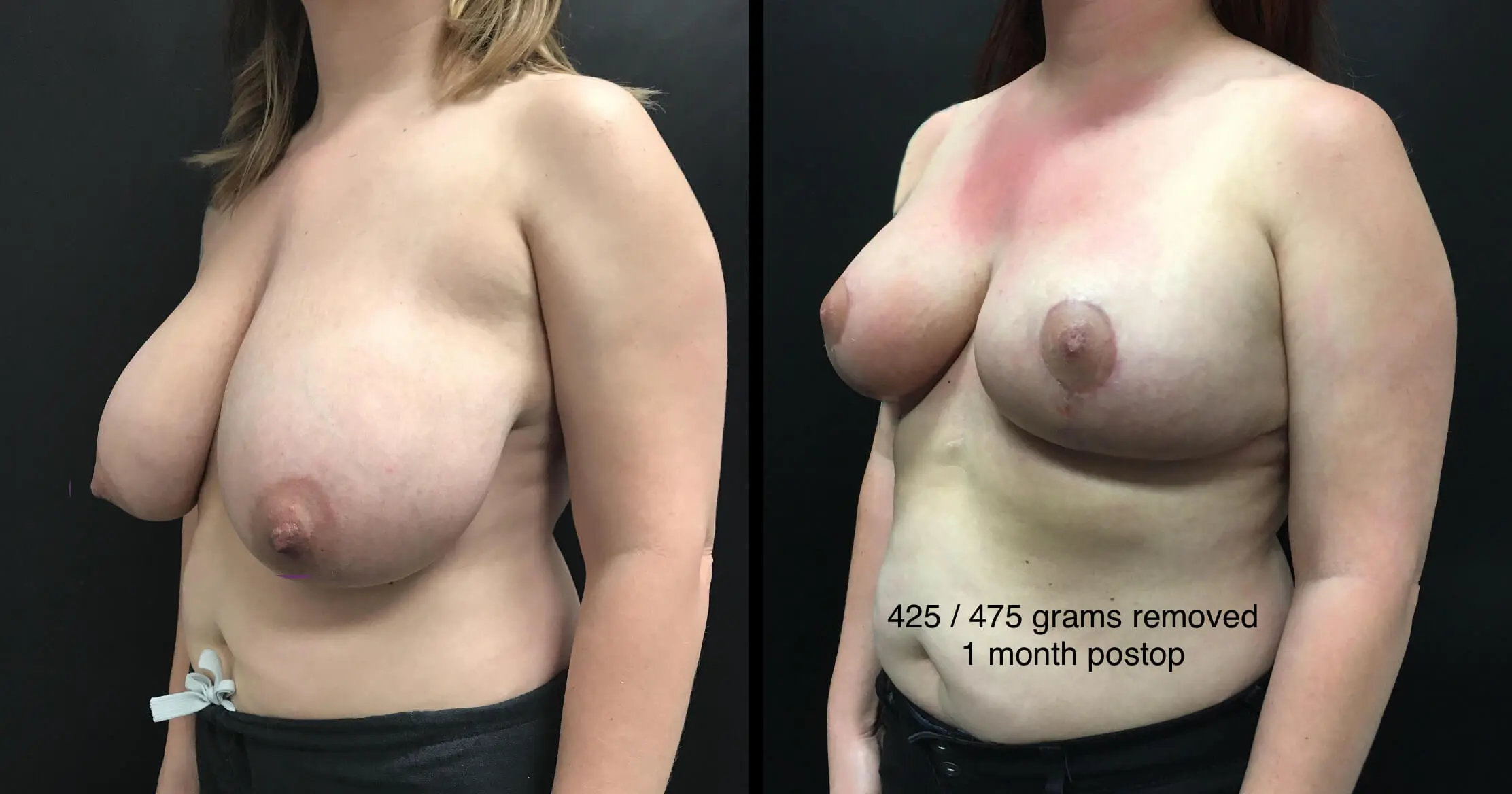 BREAST REDUCTION Before & After Case Number 0003