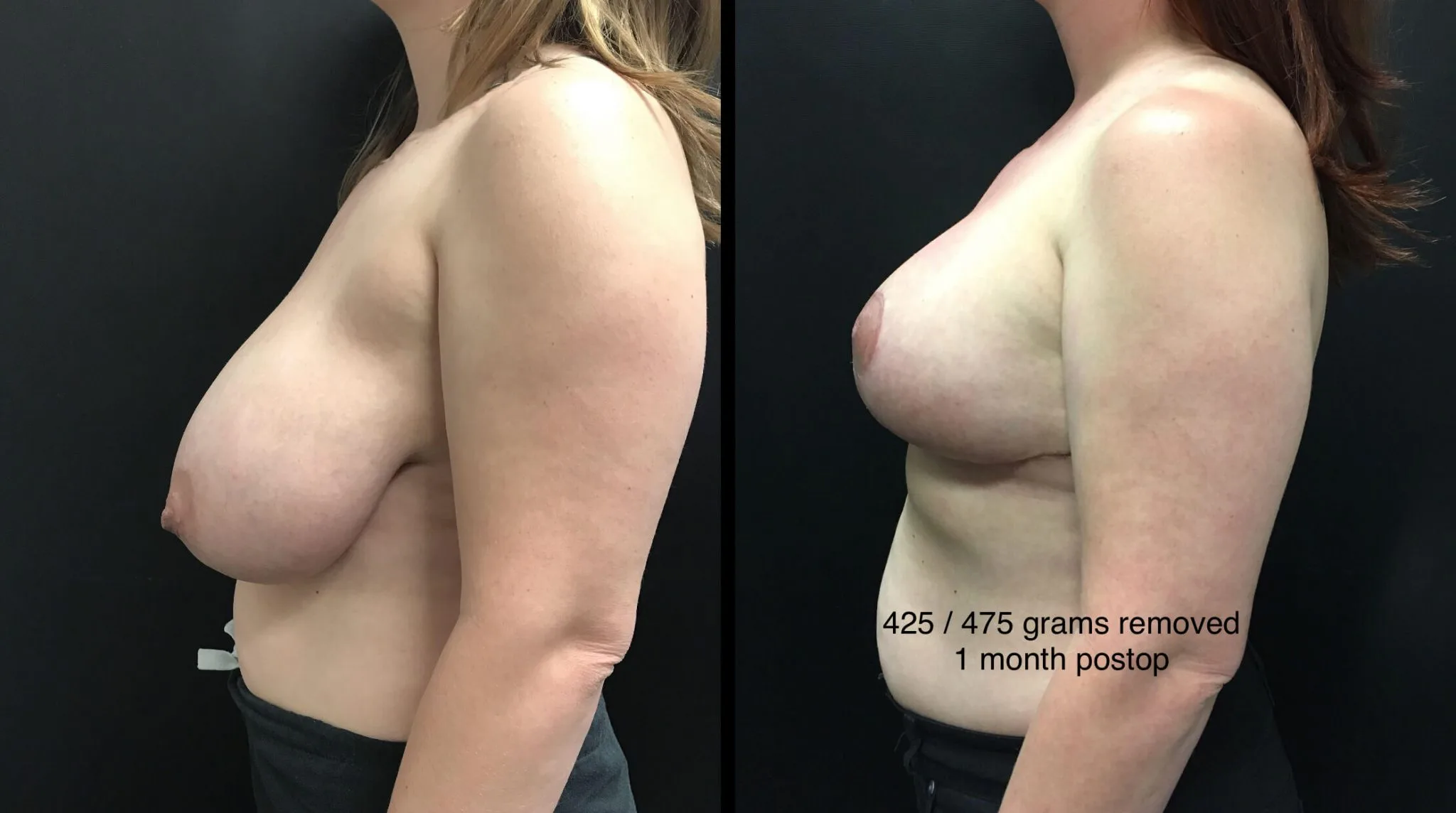 BREAST REDUCTION Before & After Case Number 0003