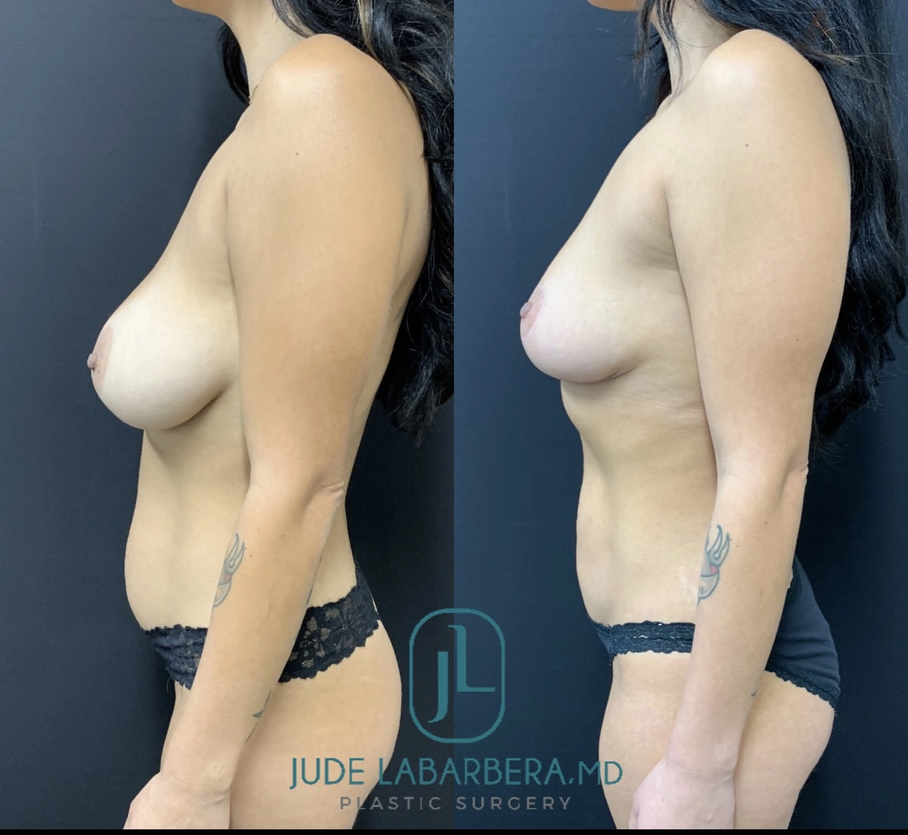 Breast Surgery Before & After Case Number 00013