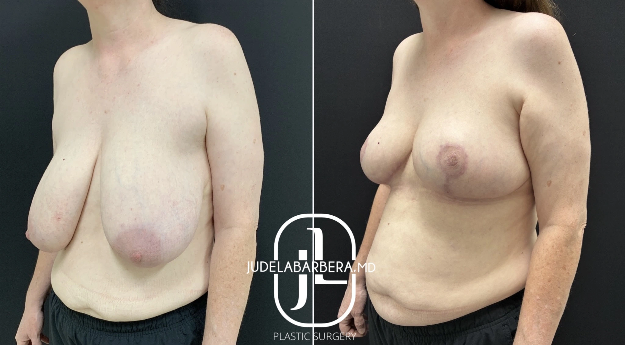 Breast Reduction - Case 009