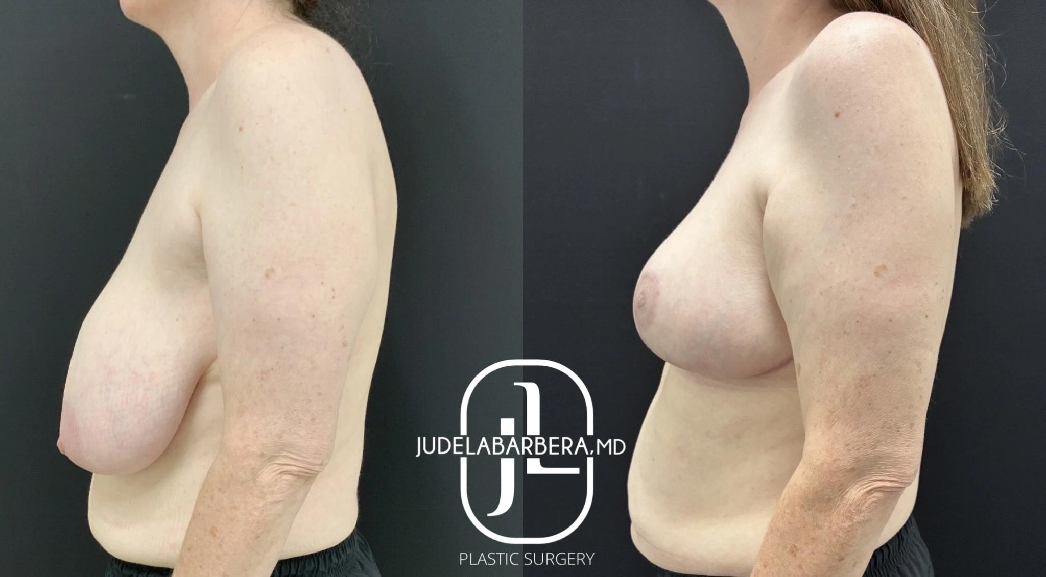 Breast Reduction - Case 009