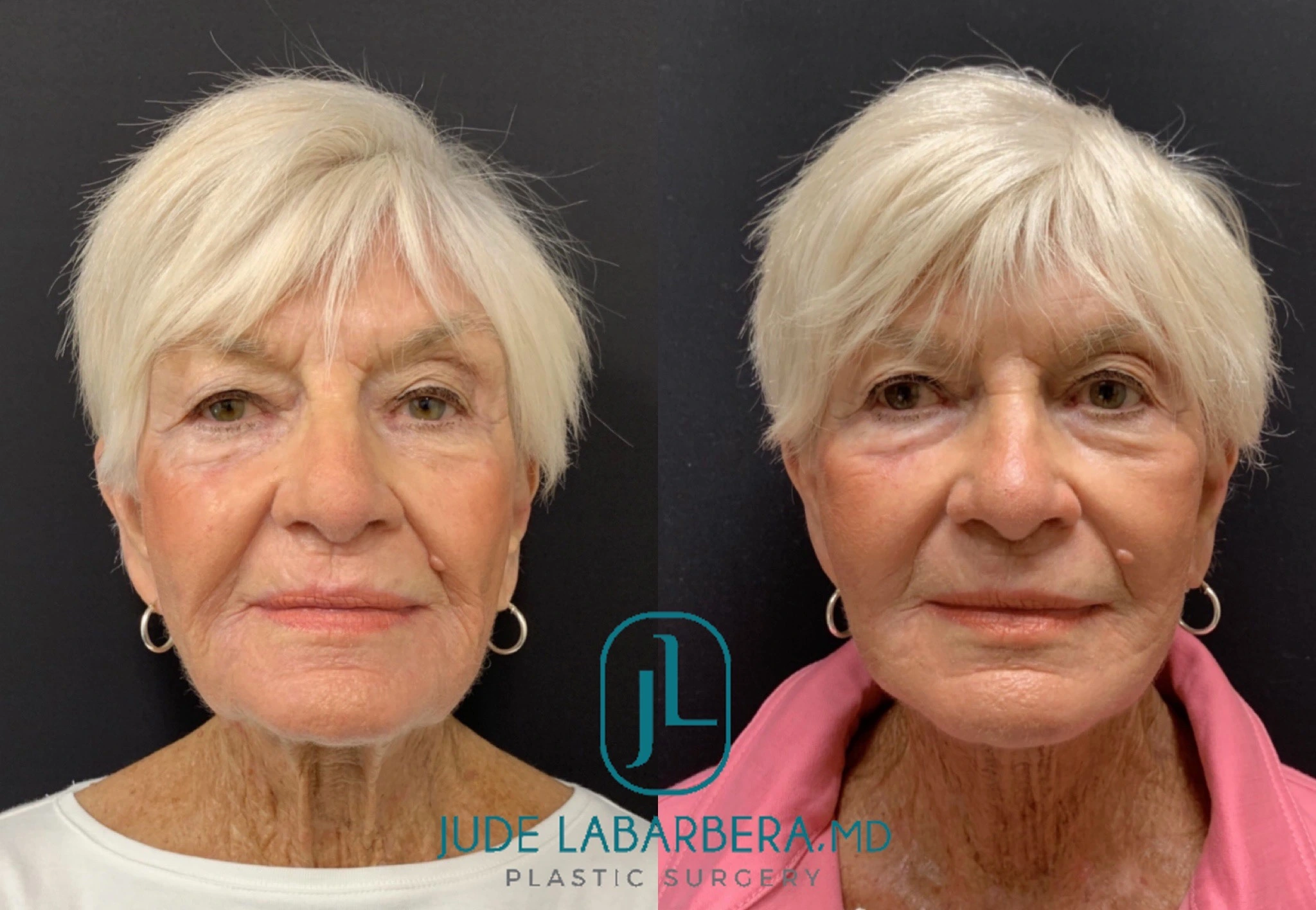 FACELIFT Before & After Case Number 0006