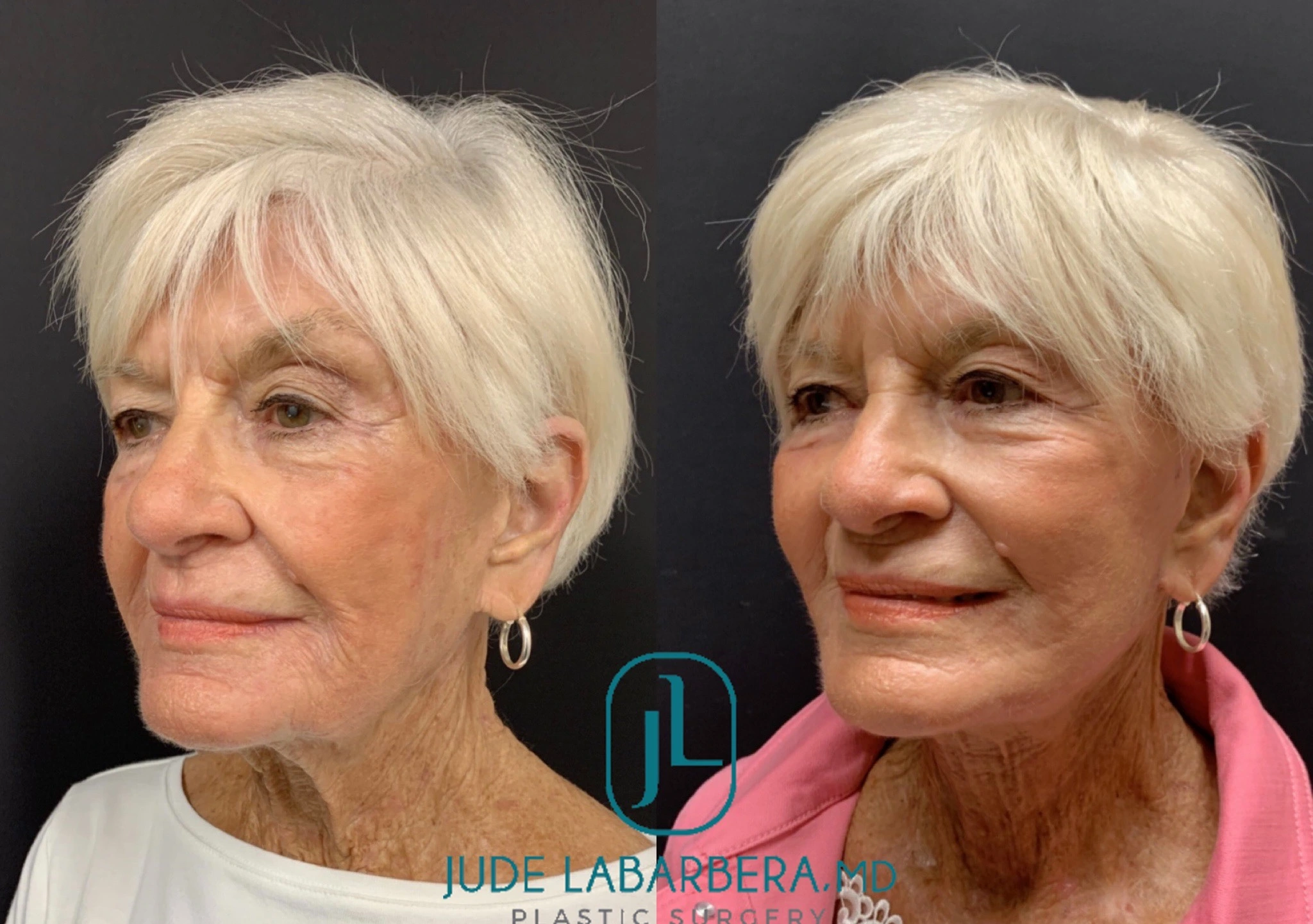 FACELIFT Before & After Case Number 0006