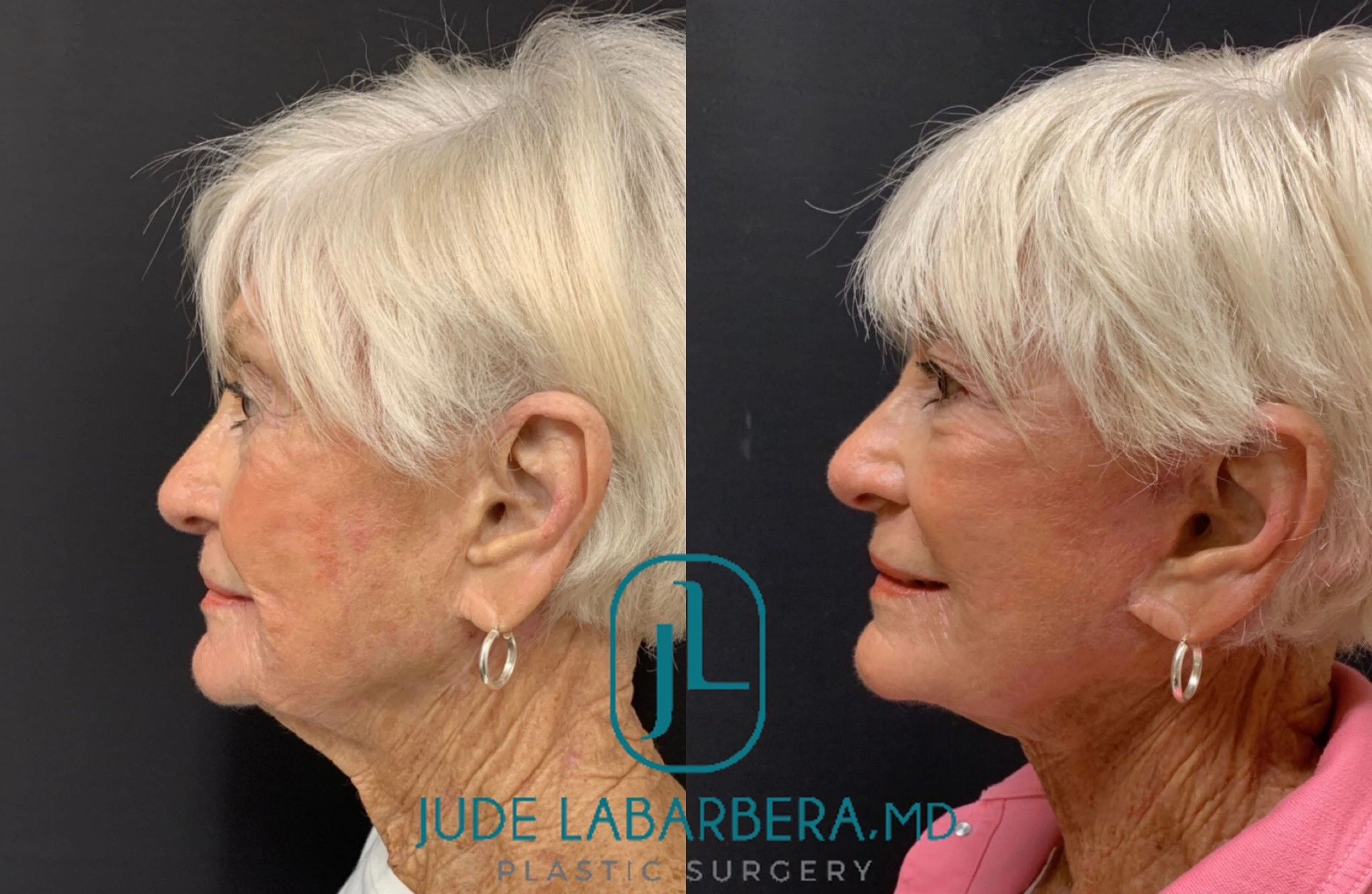 FACELIFT Before & After Case Number 0006
