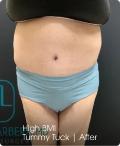High BMI Tummy Tuck: After Banner