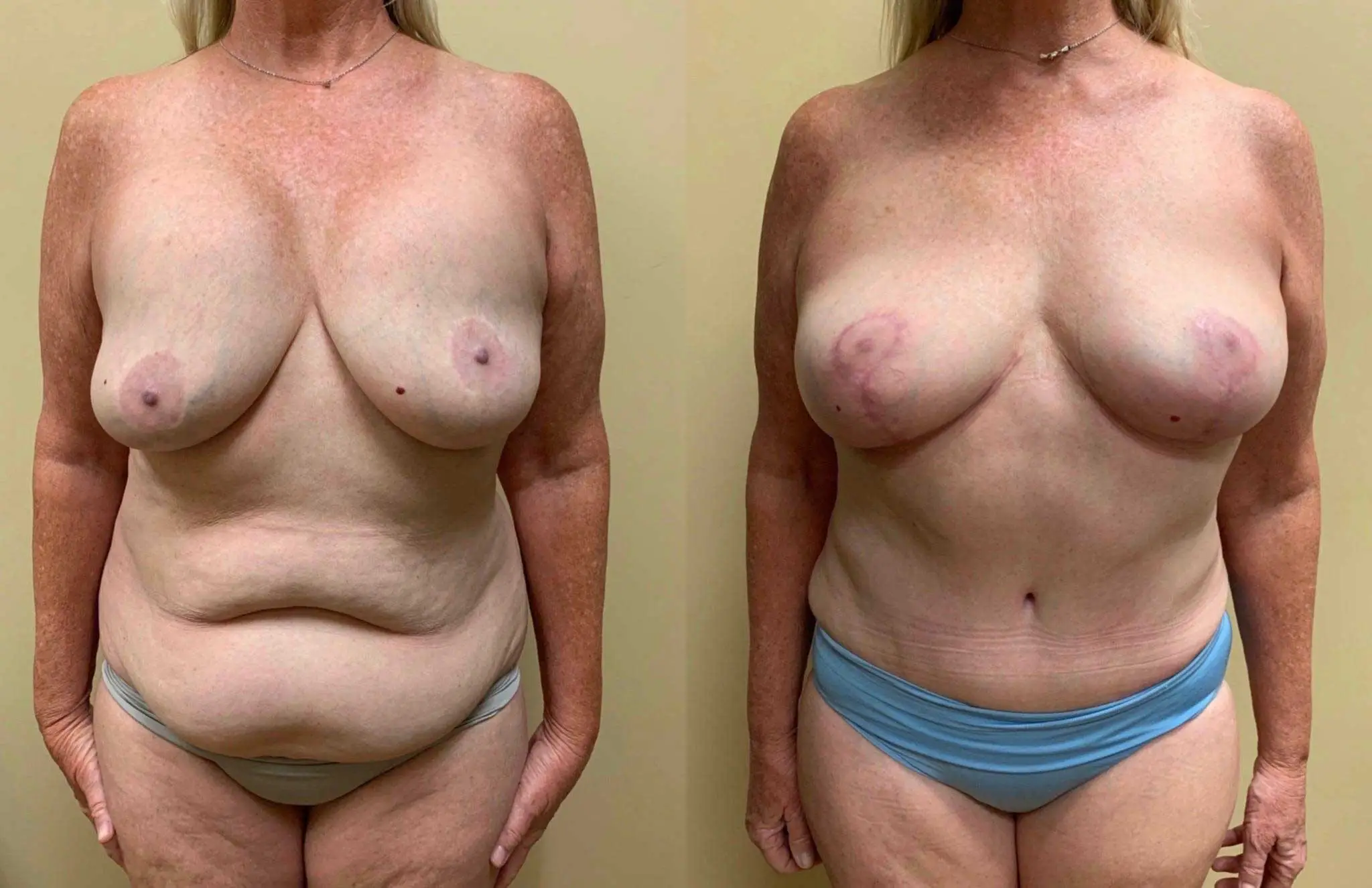 IMPLANT REMOVAL Before & After Case Number 000117