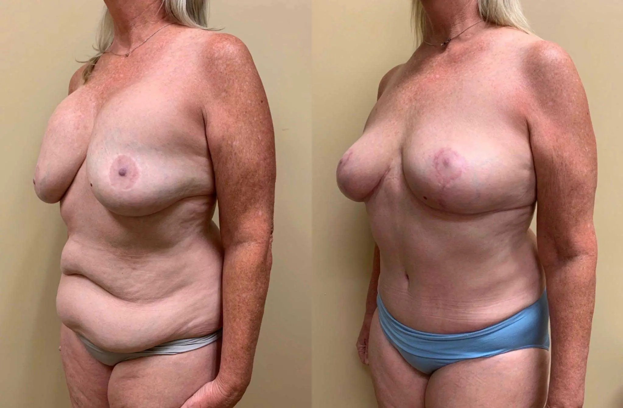 IMPLANT REMOVAL Before & After Case Number 000117