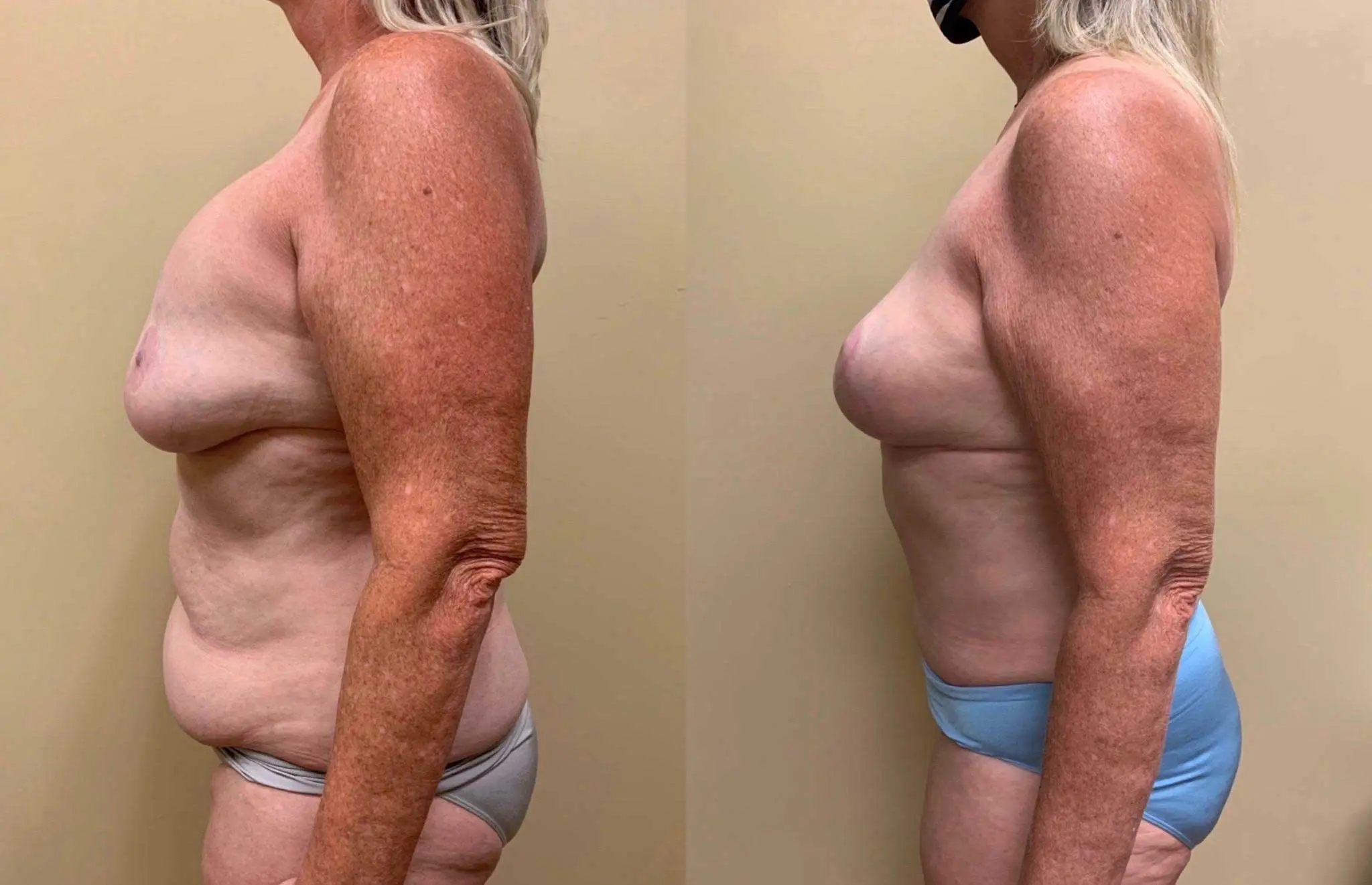 IMPLANT REMOVAL Before & After Case Number 000117