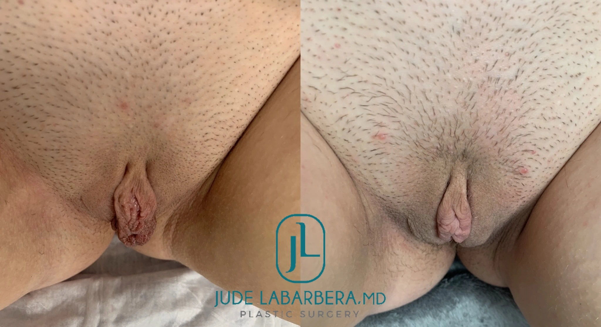 Labiaplasty before & after Case Number 0008