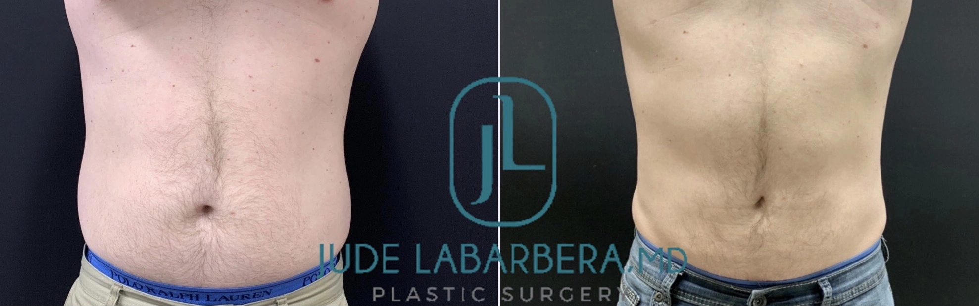 LIPOSUCTION Before & After Case Number 00010