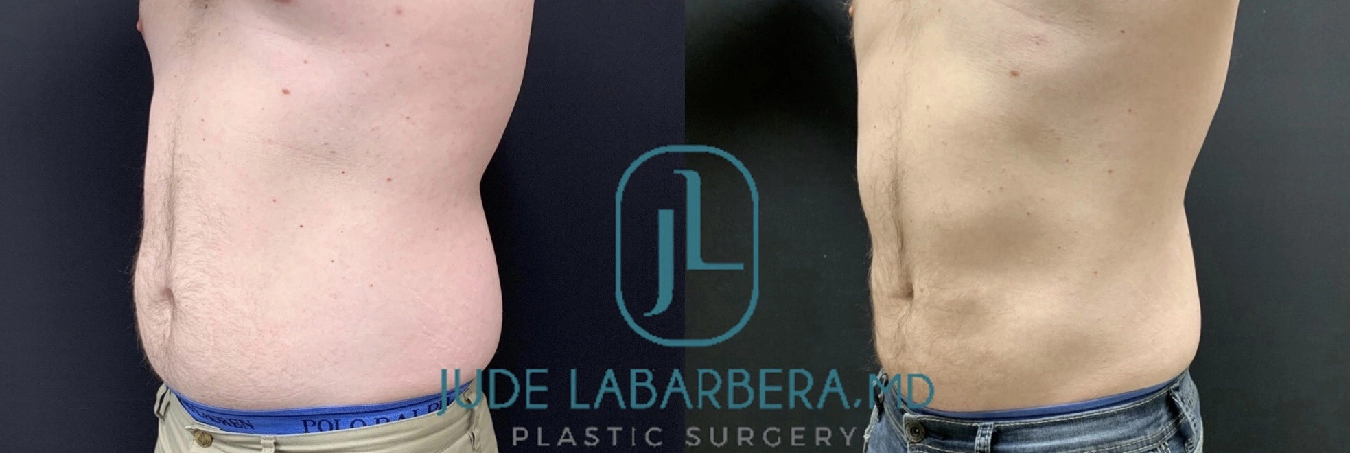 LIPOSUCTION Before & After Case Number 00010