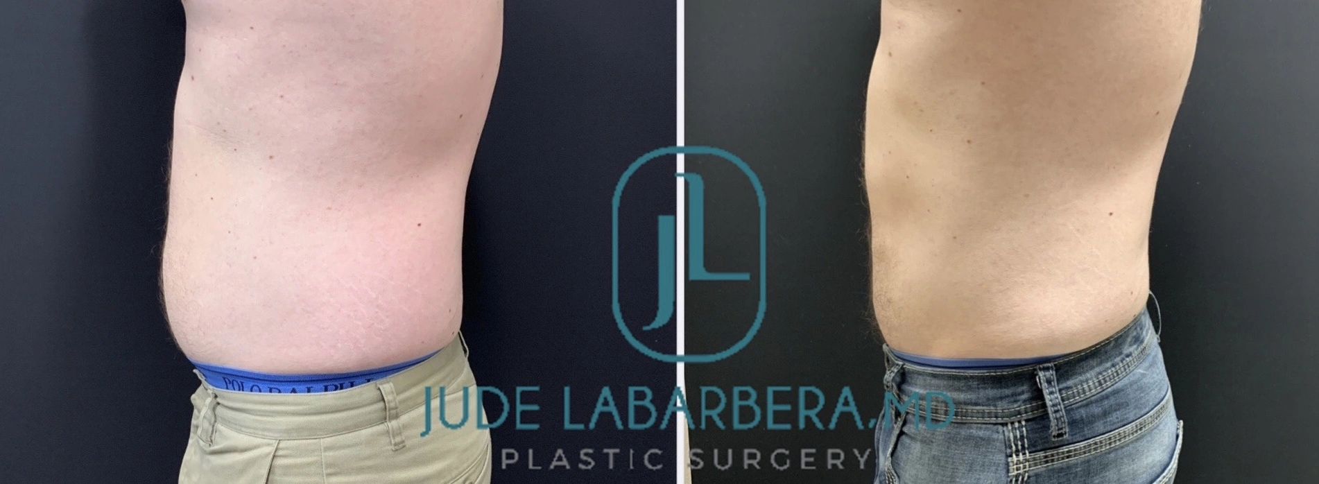 LIPOSUCTION Before & After Case Number 00010