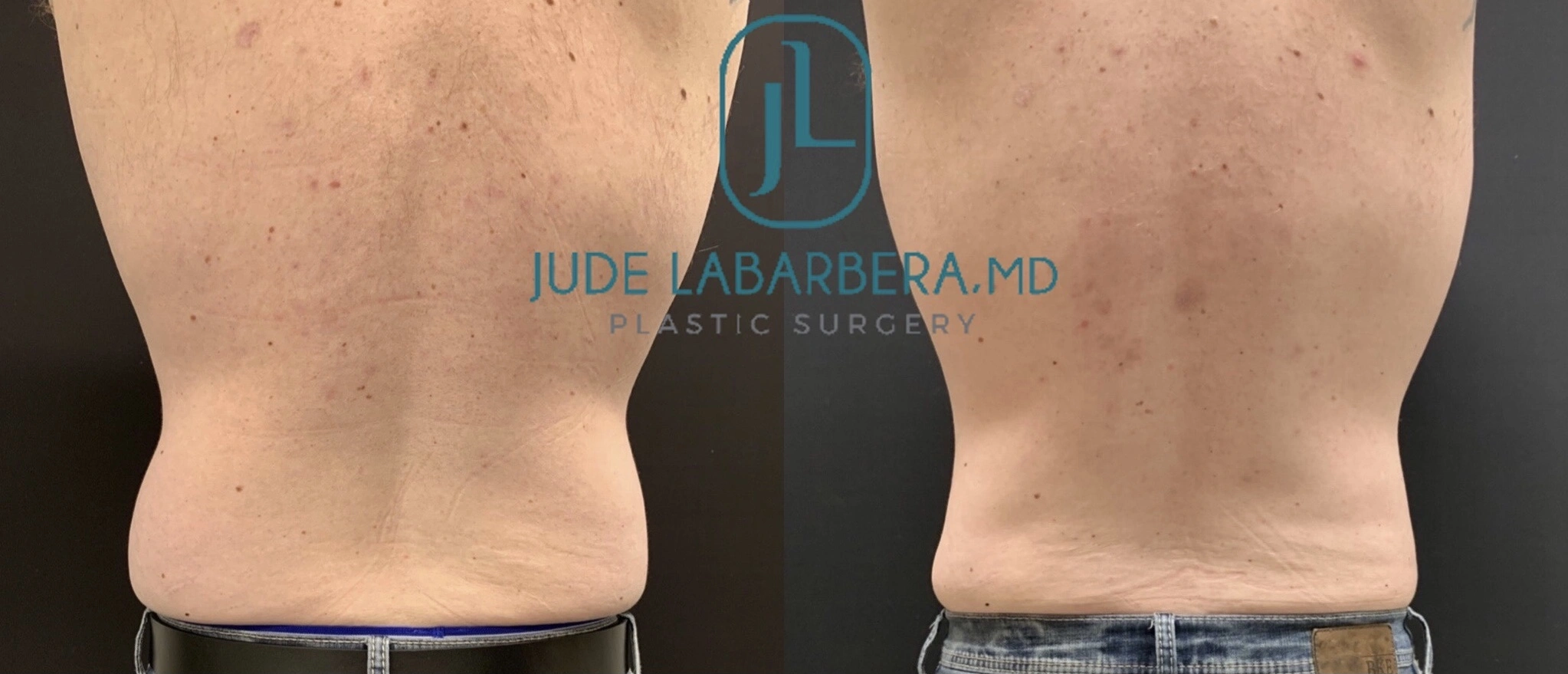 LIPOSUCTION Before & After Case Number 00010