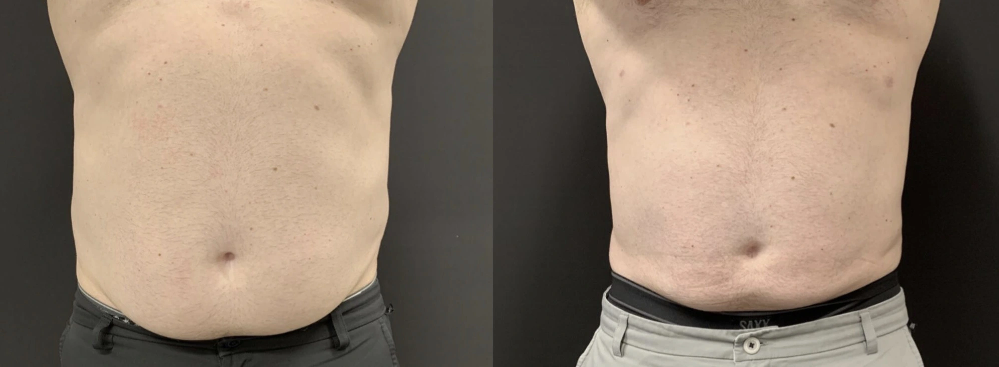 LIPOSUCTION Before & After Case Number 0009