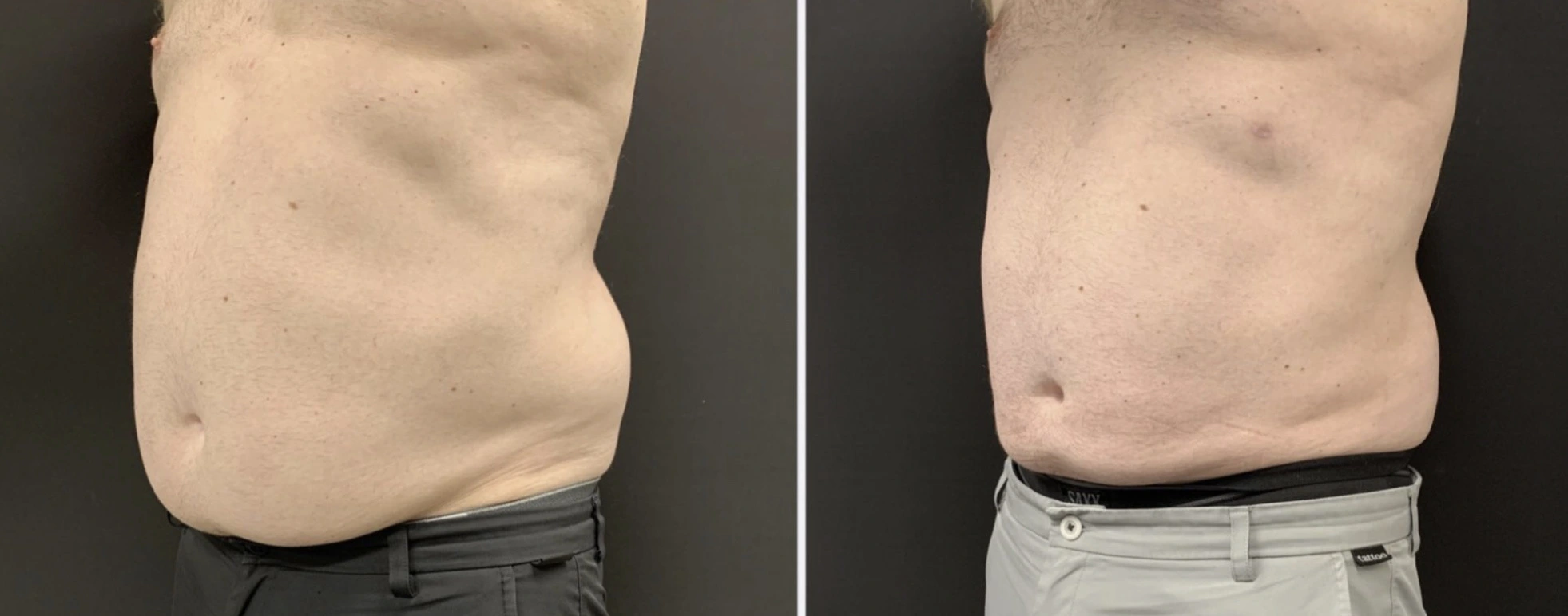 LIPOSUCTION Before & After Case Number 0009