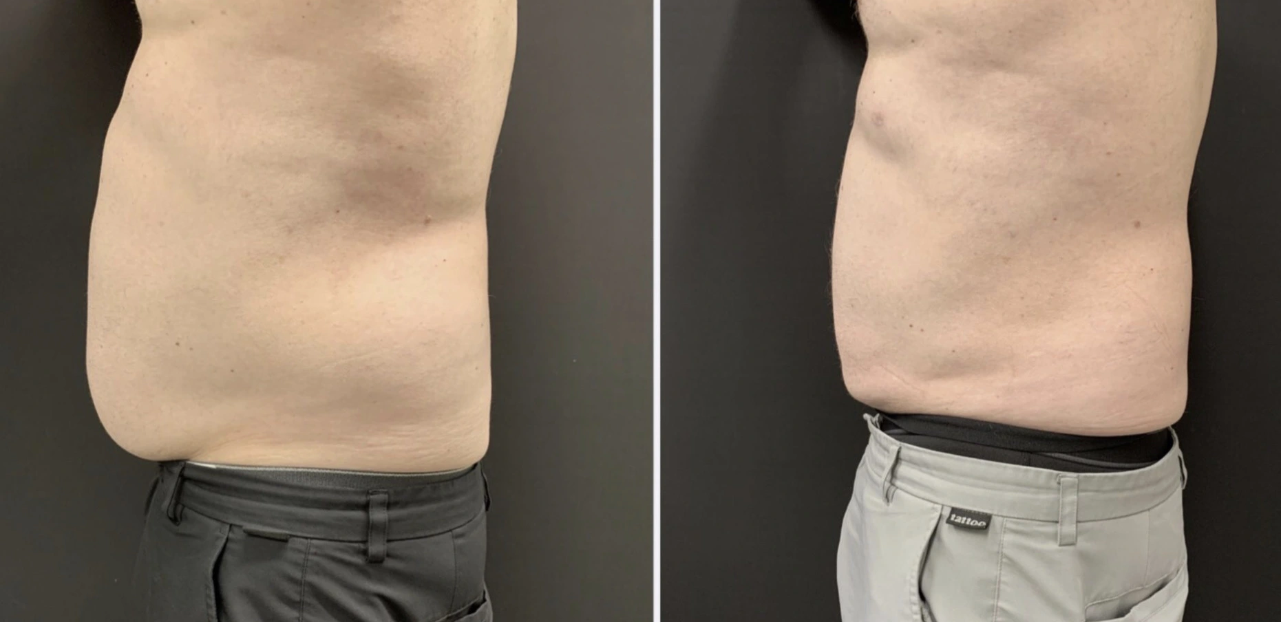 LIPOSUCTION Before & After Case Number 0009