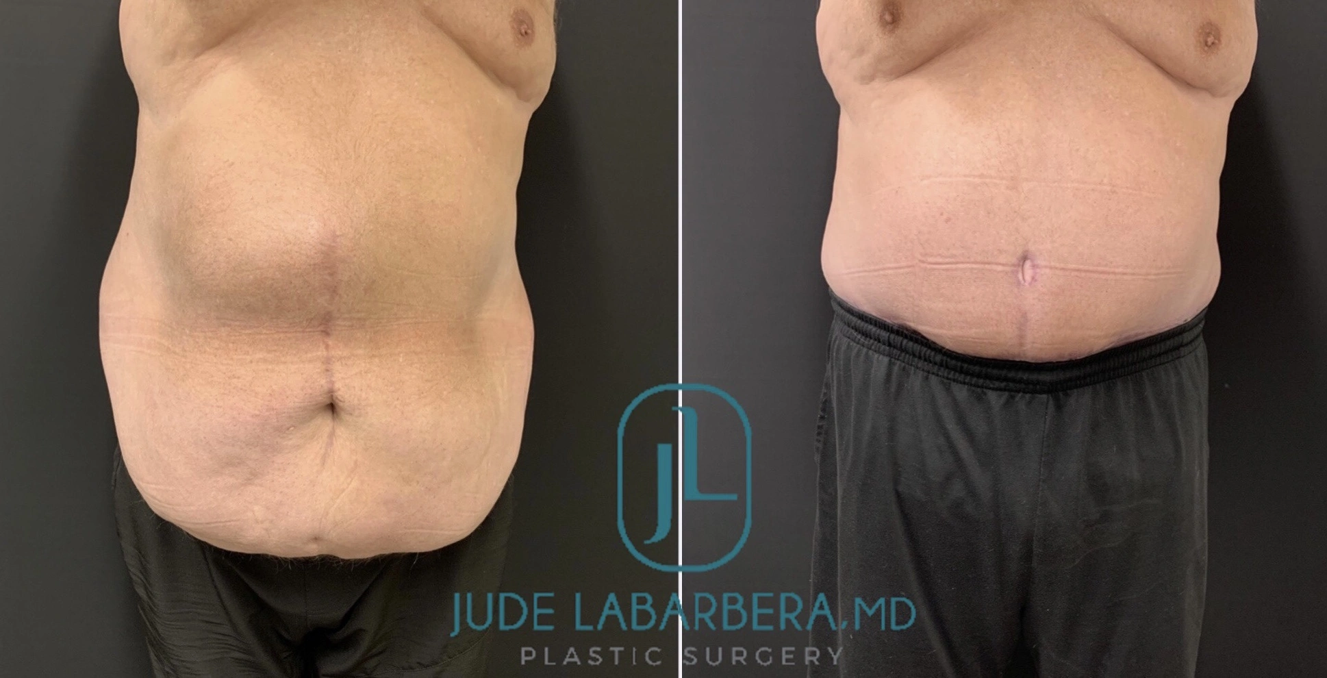 MALE TUMMY TUCK Before & After Case Number 00098