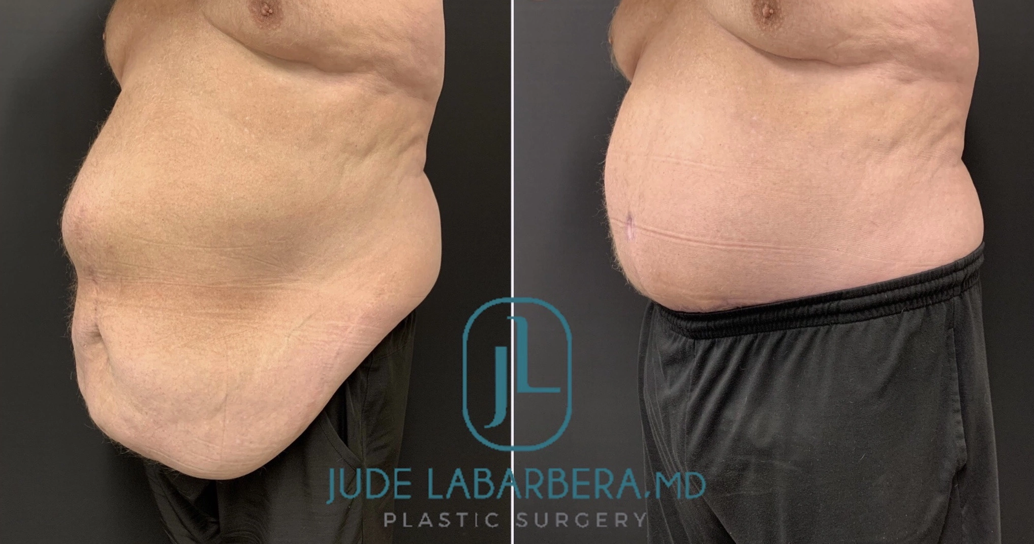 MALE TUMMY TUCK Before & After Case Number 00098